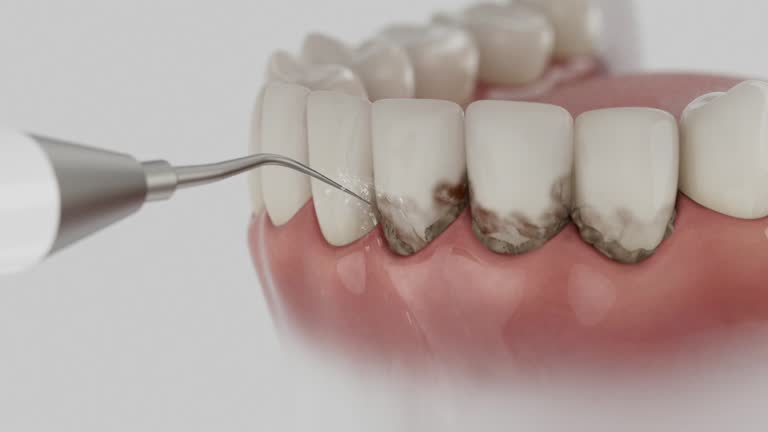 Trusted Teeth Cleaning And Checkup service in West Samoset, FL - Dentist Open Now